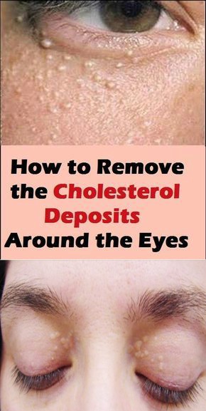 How to Remove the Cholesterol Deposits Around Your Eyes