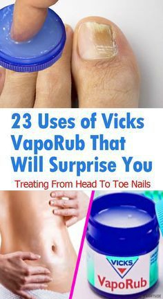 23 Uses of Vicks VapoRub That Will Surprise You – Treating From Head To Toe Nails