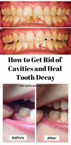 13 2 HOW TO GET RID OF CAVITIES AND HEAL TOOTH DECAY