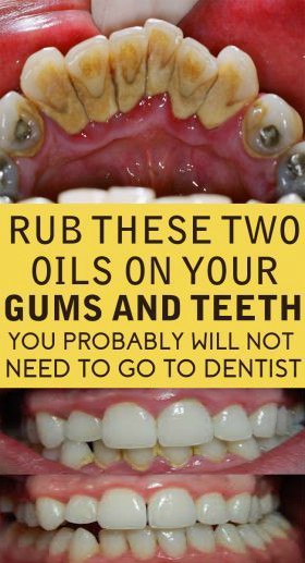 Rub These Two Oils On Your Gums And Teeth