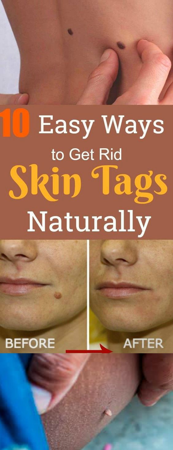How to Get Rid of Skin Tags-10 Easy Natural Painless Ways