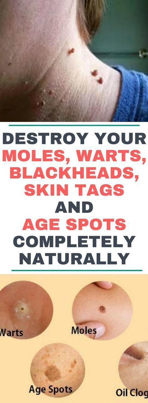 Destroy Your Moles, Warts, Blackheads, Skin Tags And Age Spots Completely Naturally