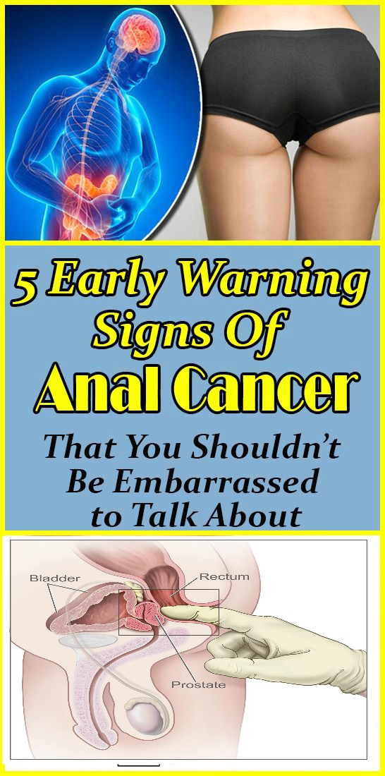 5 Early Warning Signs Of Anal Cancer That You Shouldn’t Be Embarrassed to Talk About