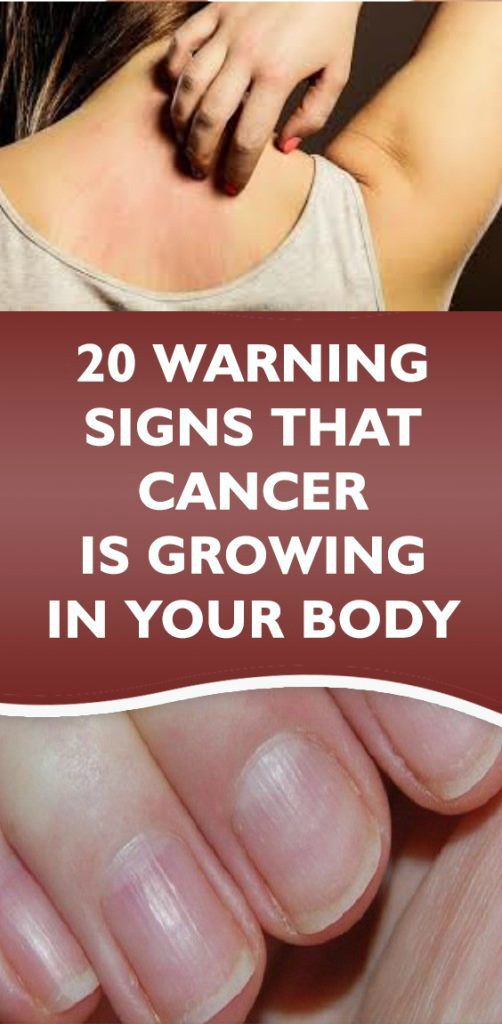 20 Warning Signs that Cancer is Growing in Your Body