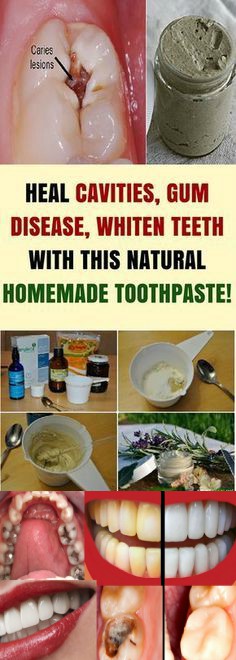HEAL CAVITIES, GUM DISEASE, AND WHITEN TEETH WITH THIS NATURAL HOMEMADE TOOTHPASTE!