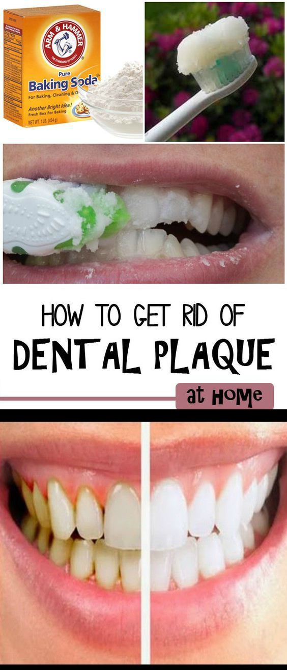 How to Remove Dental Plaque