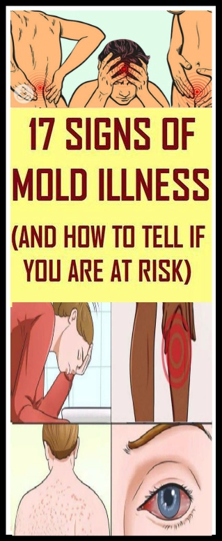Here Are 17 Signs Of Mold Illness How To Tell If You’re At Risk Here Are 17 Signs Of Mold Illness & How To Tell If You’re At Risk