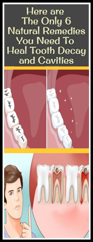 The Only 6 Natural Remedies You Need To Heal Tooth Decay and Cavities