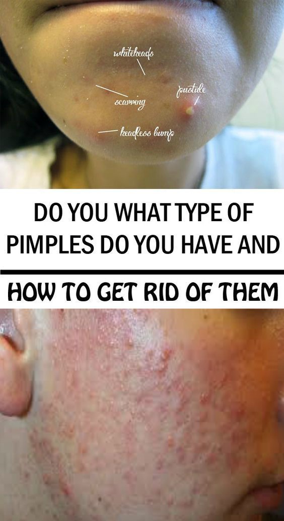 What type of pimples you have and how to get rid of them