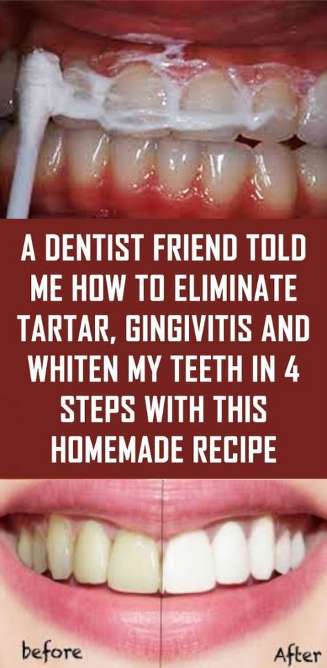 Dentist Friend Told Me How To Eliminate Tartar, Gingivitis And Whiten My Teeth In 4 Steps With This Homemade Recipe