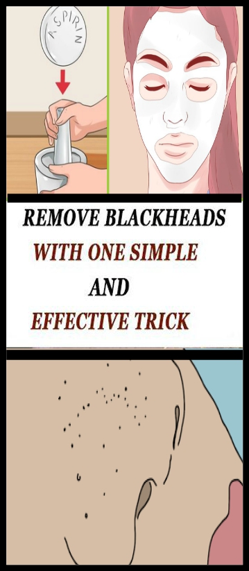 Remove Blackheads With One Simple And Effective Trick