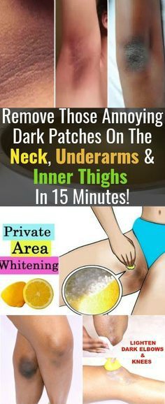 Remove Those Annoying Dark Patches On The Neck, Underarms And Inner Thighs In 15 Minutes!