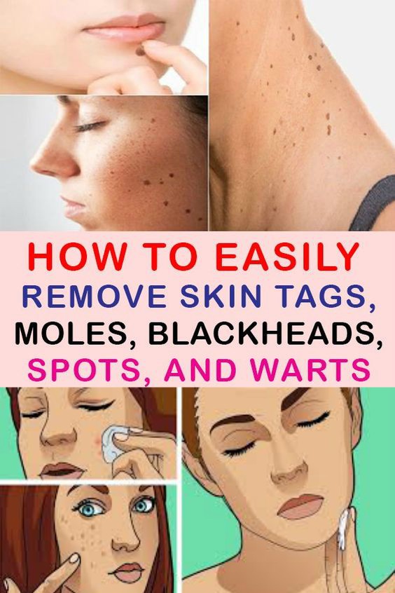 How to Easily Remove Skin Tags, Moles, Blackheads, Spots, and ...