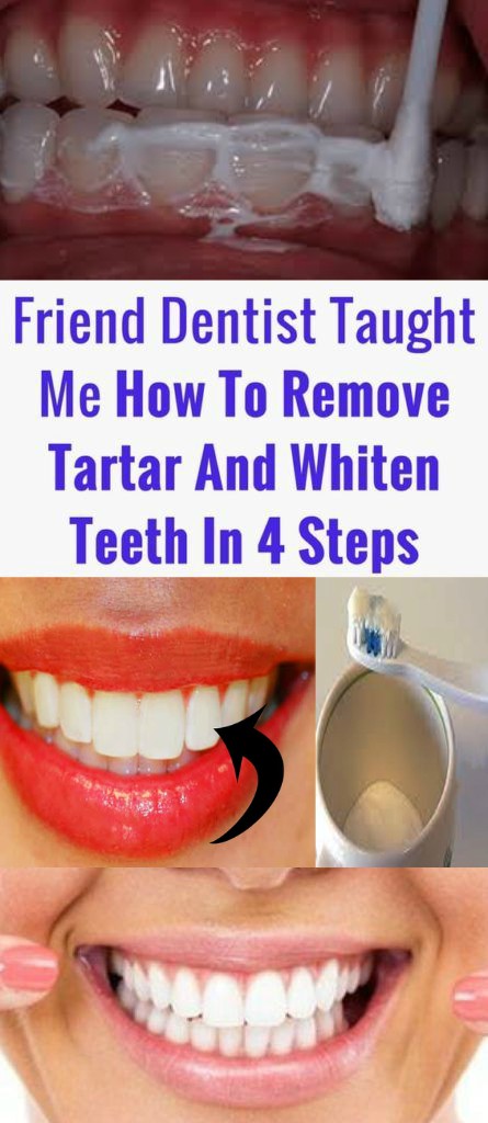 A Friend Dentist Taught Me How To Remove Tartar And Whiten Teeth In 4 Steps