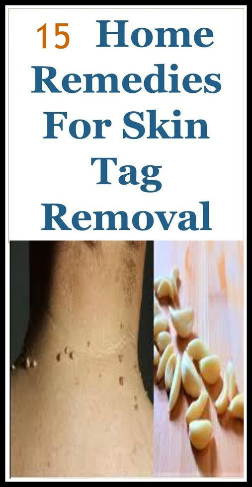 15 Effective Home Remedies For Skin Tag Removal
