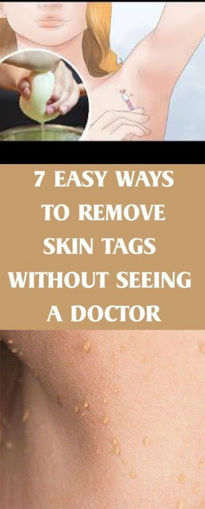 7 Easy Ways To Remove Skin Tags Without Seeing A Doctor