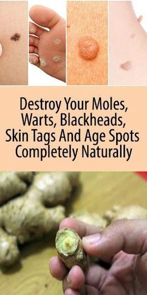 DESTROY YOUR MOLES, WARTS, BLACKHEADS, SKIN TAGS AND AGE SPOTS COMPLETELY NATURALLY