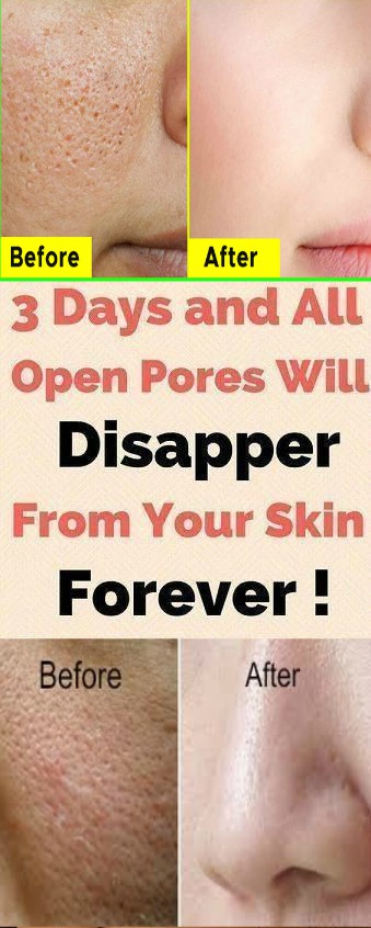 how to get rid of enlarged pores naturally