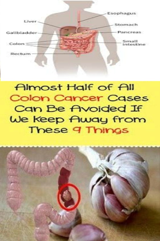 Almost Half of All Colon Cancer Cases Can Be Avoided If We Keep Away from These 7 Things