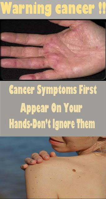 Cancer Symptoms First Appear On Your Hands-Don’t Ignore Them