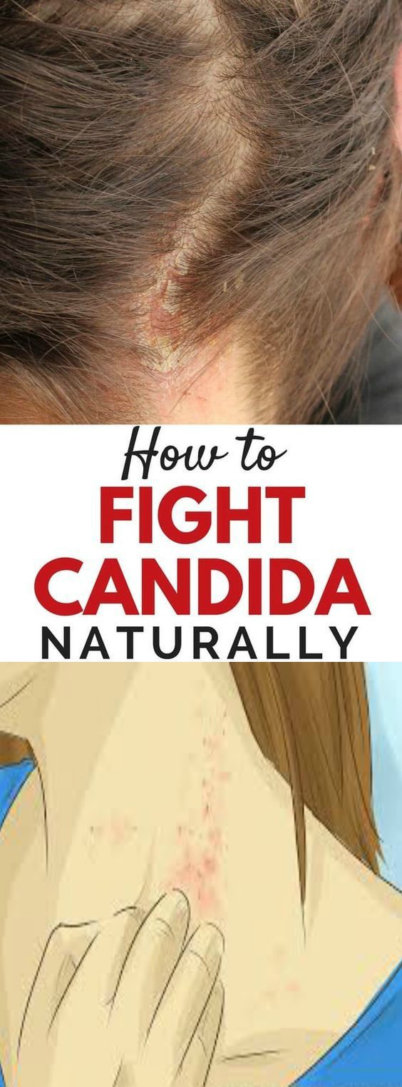3 Steps to Fighting Candida Naturally (Part 2 of the Story)