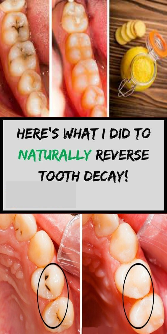 WOW! 6 amazing ways to heal tooth decay and reverse cavities naturally!