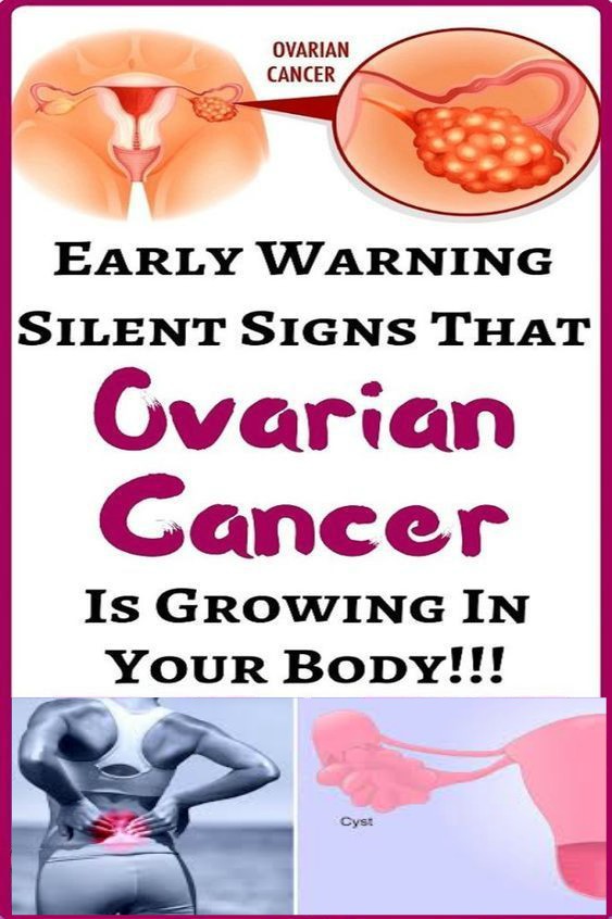 7 SIGNS OF OVARIAN CANCER YOU MIGHT BE IGNORING