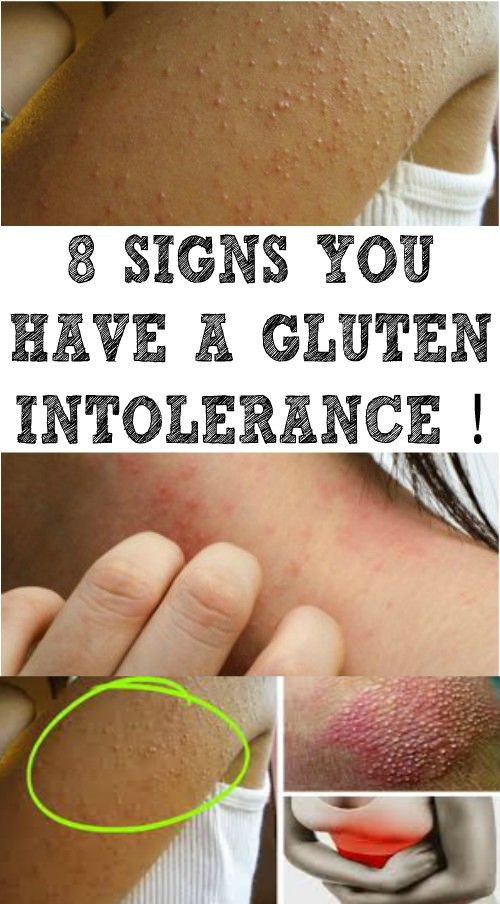 8 SIGNS YOU HAVE A GLUTEN INTOLERANCE !