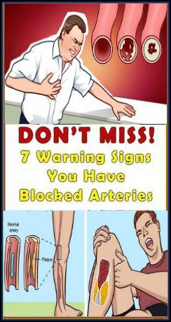 Here Are 7 Warning Signs You Have Blocked Arteries