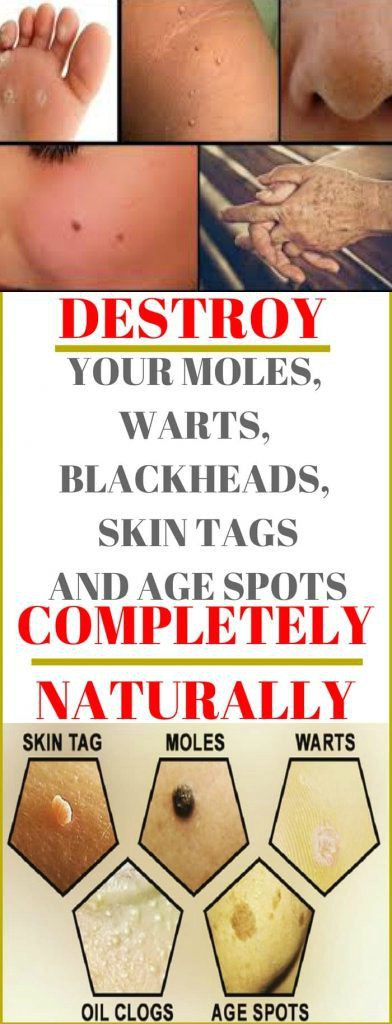 13 Destroy Your Moles, Warts, Blackheads, Skin Tags And Age Spots Completely Naturally