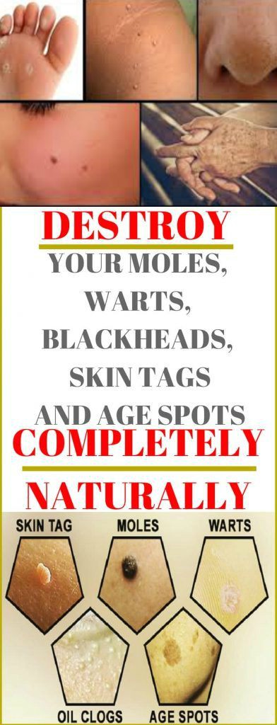 Destroy Your Moles, Warts, Blackheads, Skin Tags And Age Spots Completely Naturally