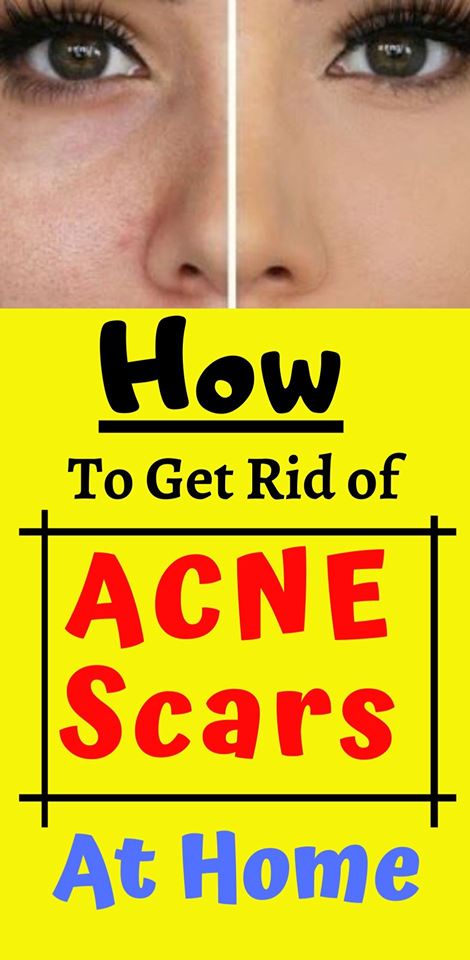 1 how to get rid of acen scars at home