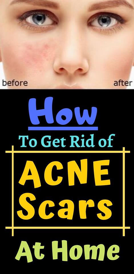 how to get rid of acen scars at home ?