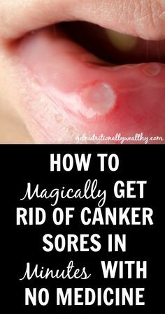 2 2 HOW TO NATURALLY GET RID OF CANKER SORES IN MINUTES WITH NO MEDICINE!