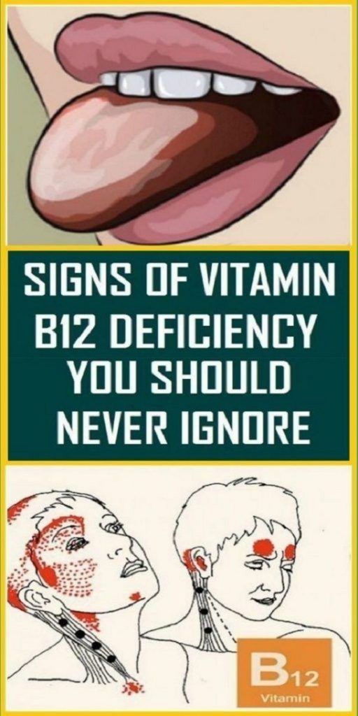 Signs of Vitamin b12 deficiency you should never ignore