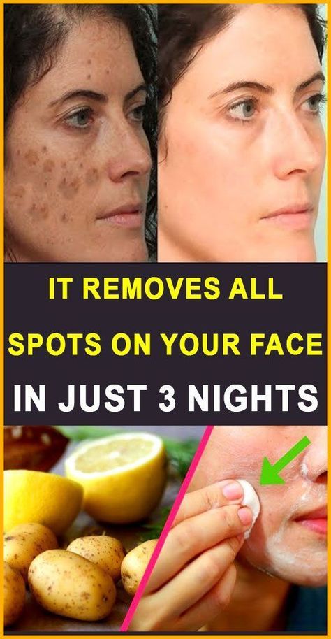 How to remove acne overnight at home